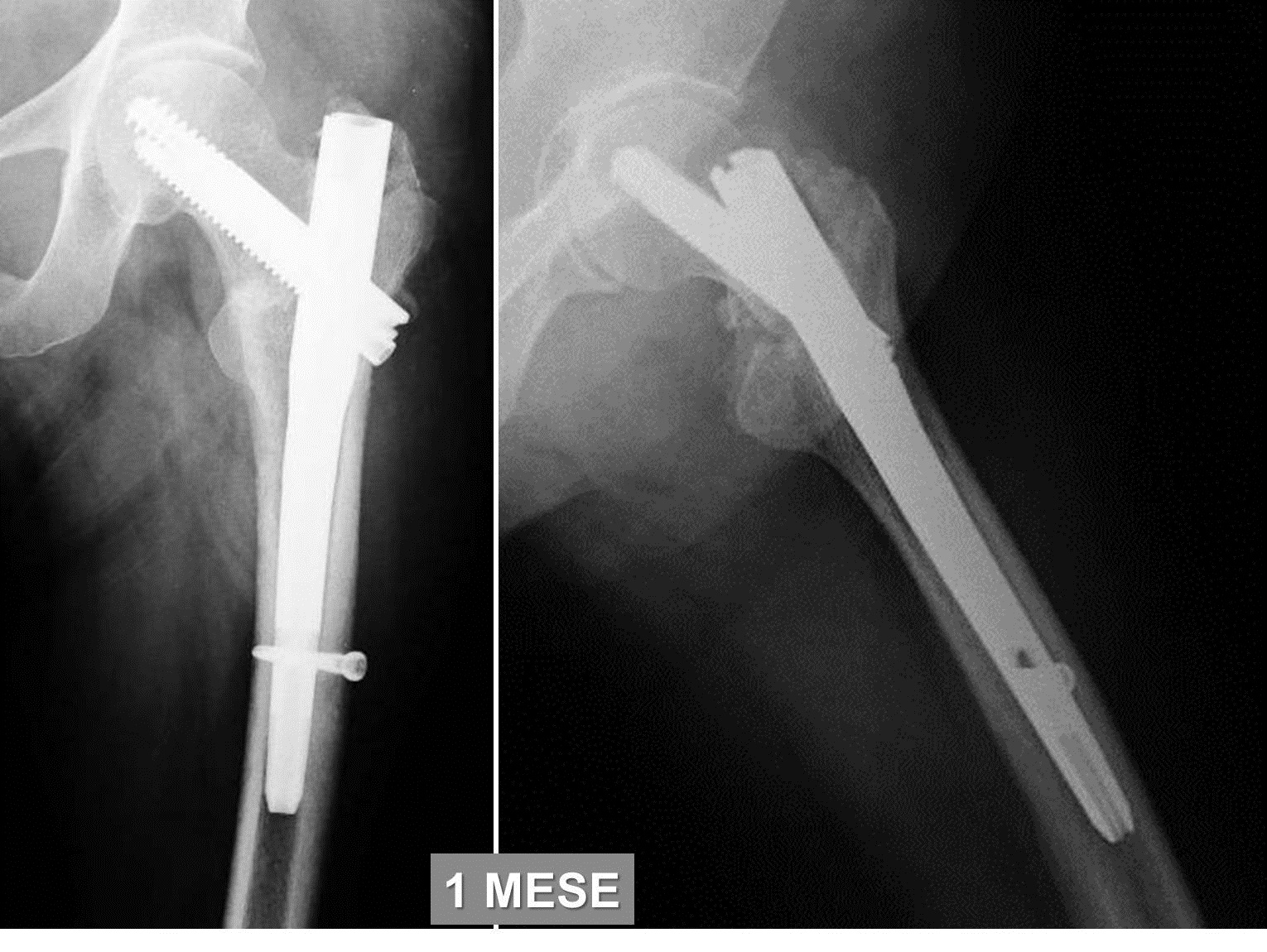 Chiodo endomidollare femore riabilitazione