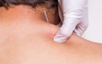 Effetti fisiologici del dry needling