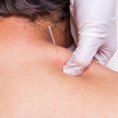 Effetti fisiologici del dry needling