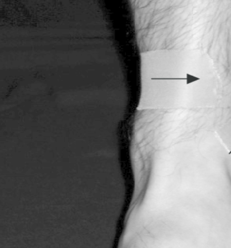 Modificazioni neuromuscolari con l’applicazione del tape di riposizionamento articolare in soggetti con instabilità cronica di caviglia