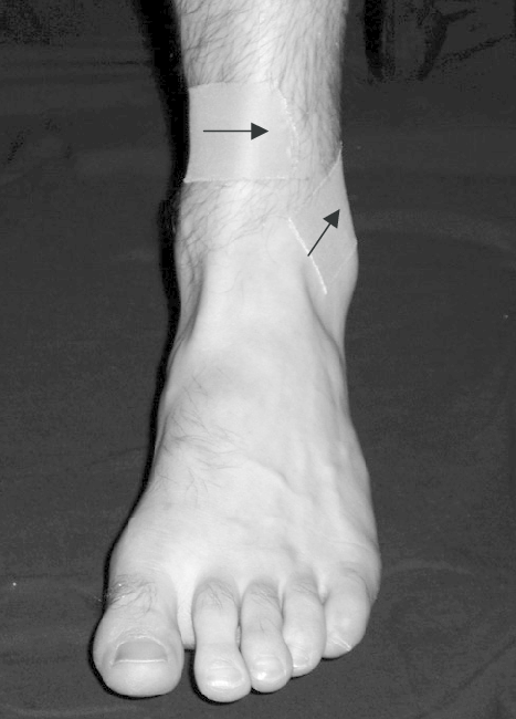 Modificazioni neuromuscolari con l’applicazione del tape di riposizionamento articolare in soggetti con instabilità cronica di caviglia