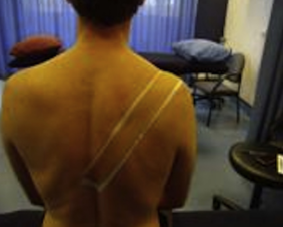 Risposta nel breve termine ad un singolo trattamento di MWM con e senza tape nella spalla dolorosa