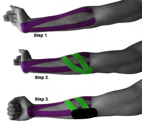 Efficacia del Kinesio Tape negli atleti con tendinopatia mediale di gomito