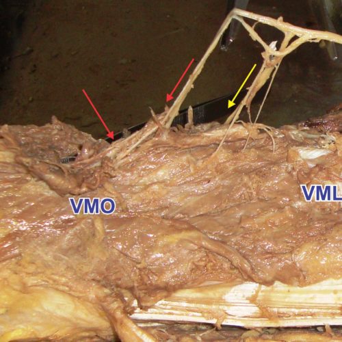 Muscoli nei muscoli: analisi del vasto mediale lungo e del vasto mediale obliquo