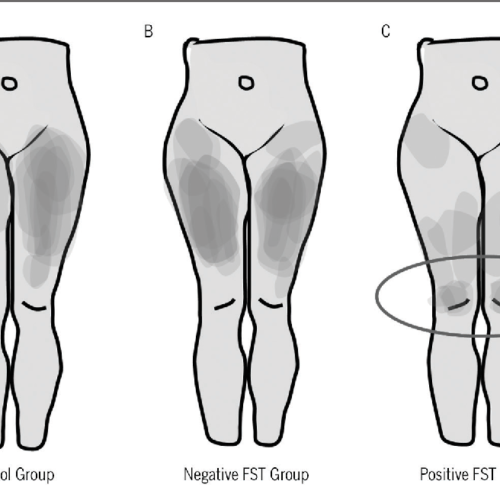 Risposta neurodinamica allo slump test femorale in soggetti con dolore anteriore di ginocchio