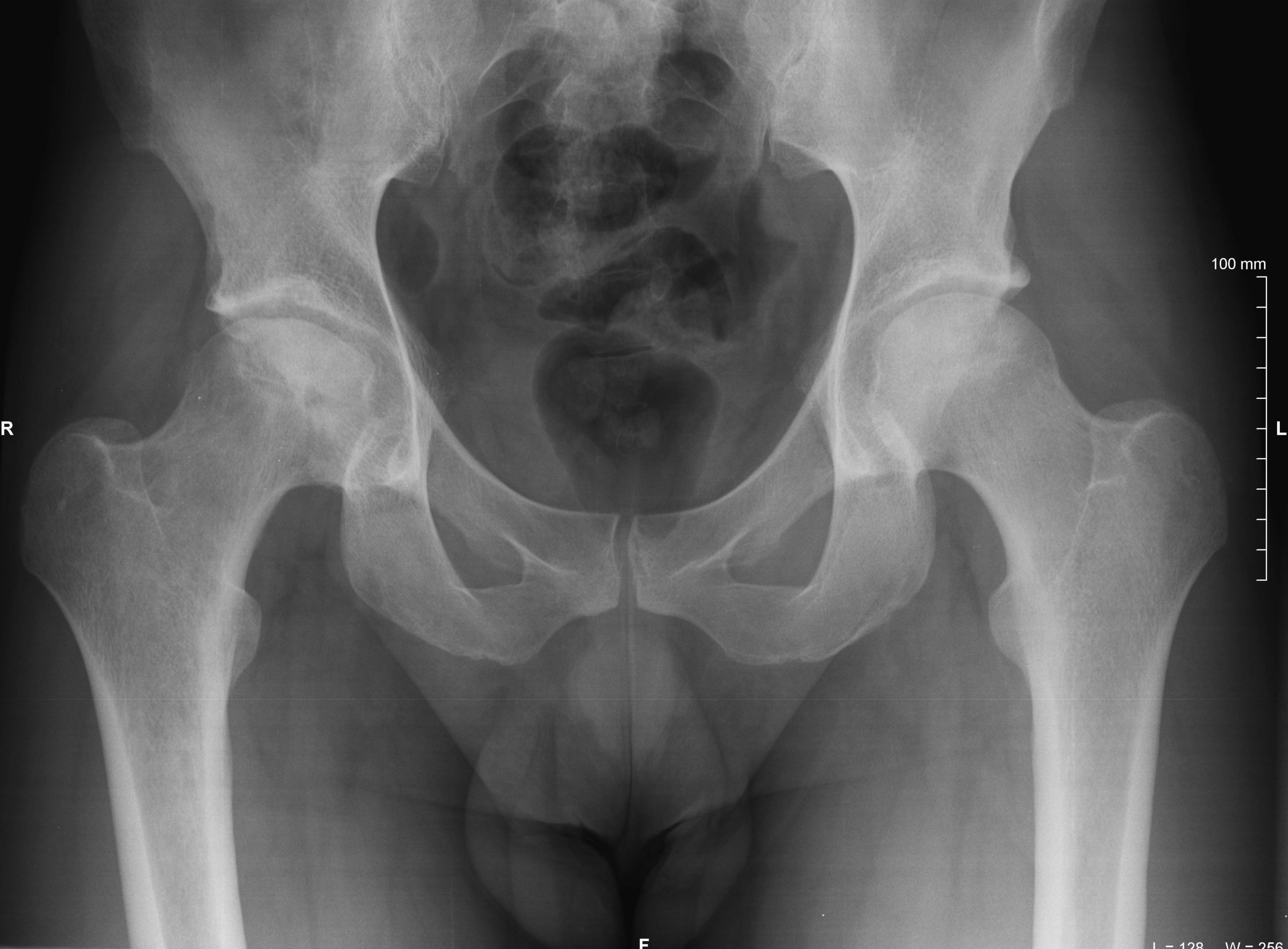 Associazione tra artrosi di anca e caratteristiche del gluteo medio