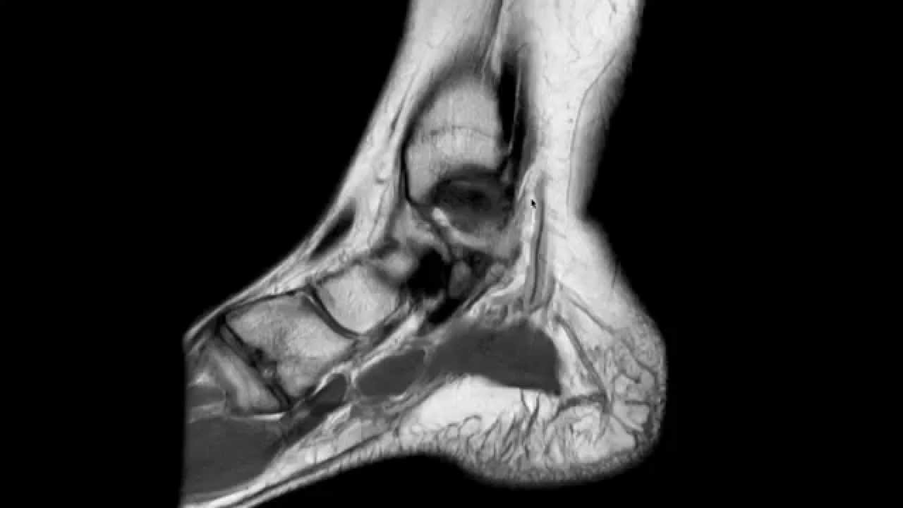 Anomalie alla risonanza magnetica dopo distorsione nella caviglia infortunata e nella controlaterale