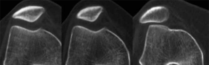 Il ruolo dello stress cartilagineo nel dolore femororotuleo