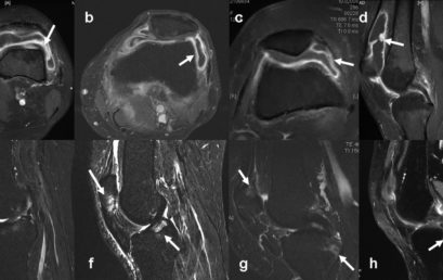 Anomalie strutturali alla risonanza magnetica in soggetti con dolore femororotuleo