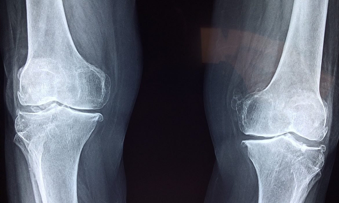 Efficacia della mobilizzazione passiva continua dopo sostituzione protesica di ginocchio