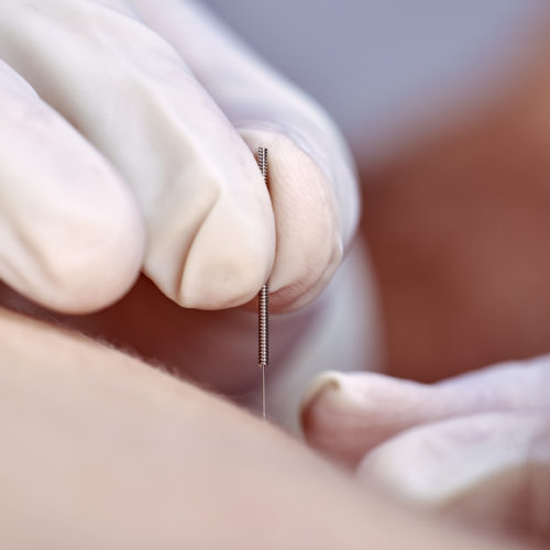 Il dry needling non aggiunge ulteriori benefici alla fisioterapia nella gestione del dolore femororotuleo