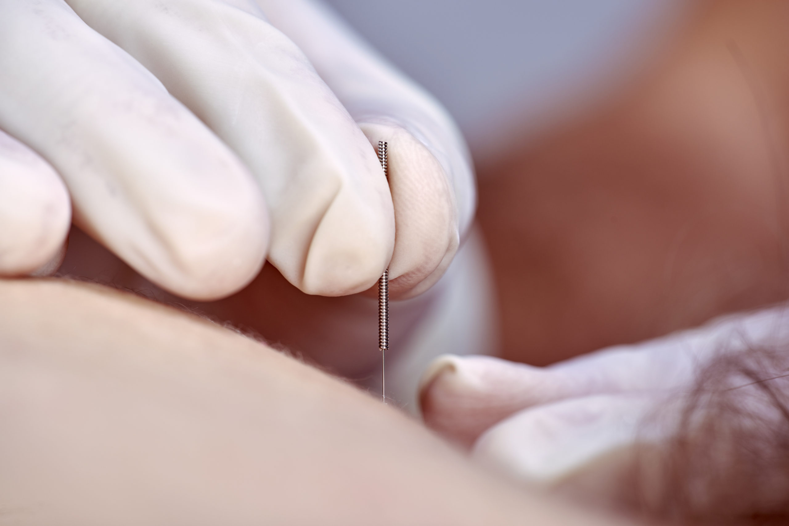 Il dry needling non aggiunge ulteriori benefici alla fisioterapia nella gestione del dolore femororotuleo