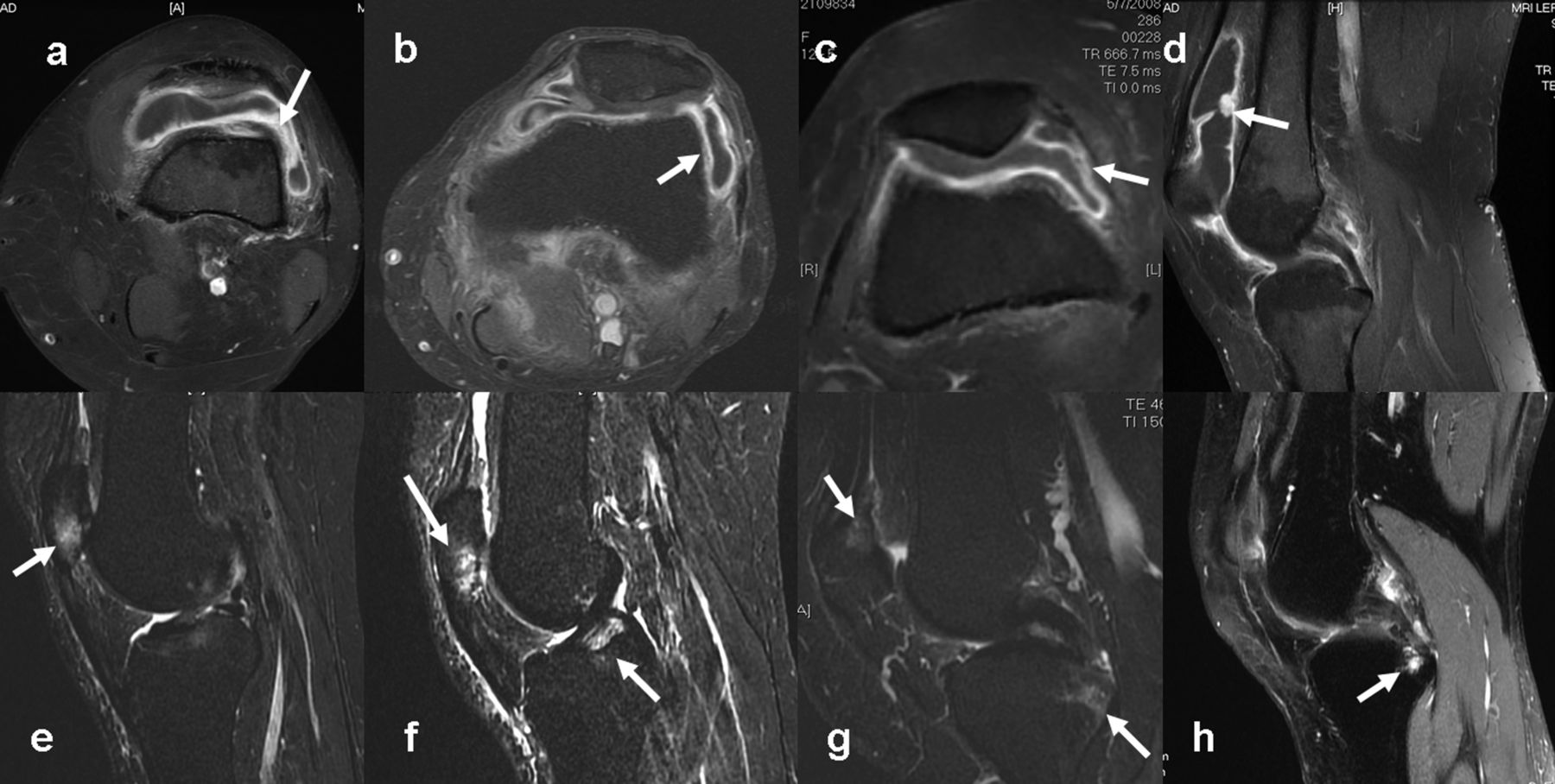 Associazione tra allineamento e morfologia dell’articolazione femororotulea e anomalie strutturali e sintomi nel dolore femororotuleo