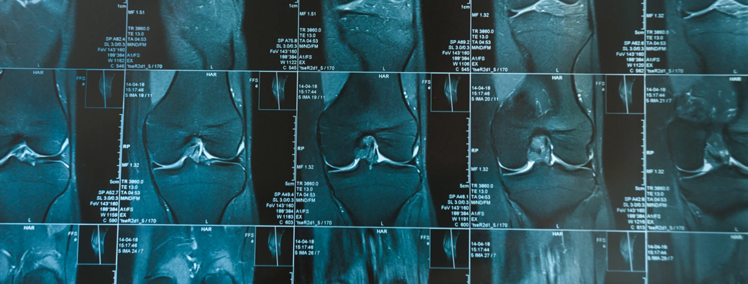 Prevalenza di alterazioni strutturali in ginocchia asintomatiche