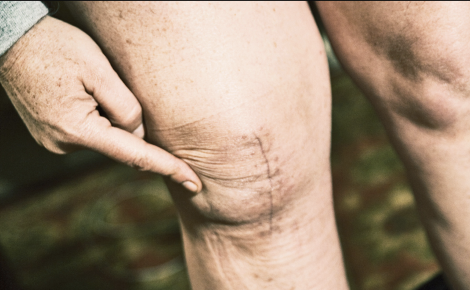 Attività sportive raccomandate dopo protesi di ginocchio