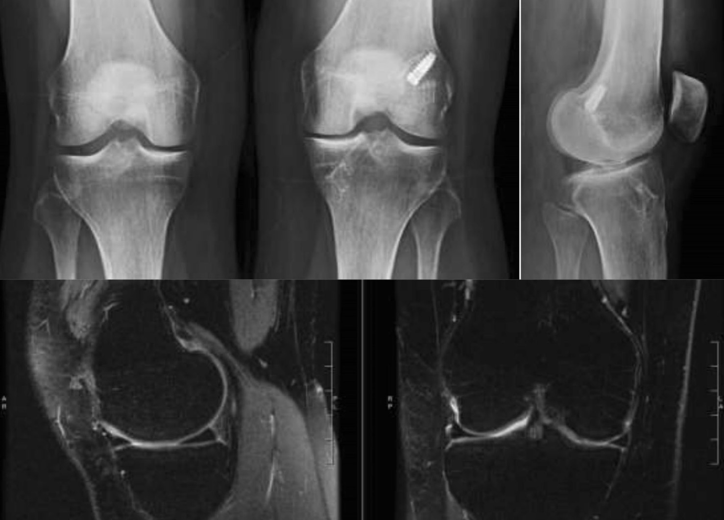 Ricostruzione del legamento crociato anteriore e artrosi di ginocchio