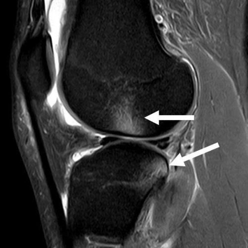 Edema osseo e degenerazione articolare dopo lesione del LCA