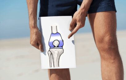 Impatto di attività fisica e sport su protesi di ginocchio